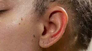 Close-up of inflamed