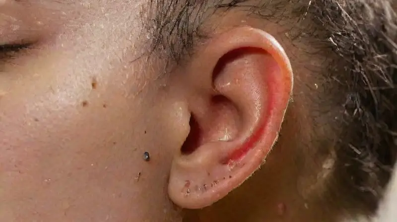 Skin reactions caused by body piercings