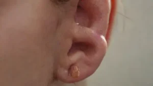 Pierced earlobe shows signs of infection